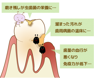 虫歯や歯周病の原因